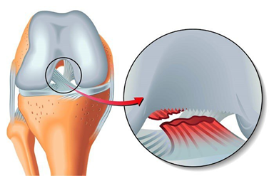 Cấu tạo khớp gối - lý do giải thích tại sao khớp gối dễ chấn thương